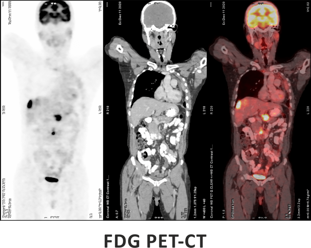 FDG PET-CT