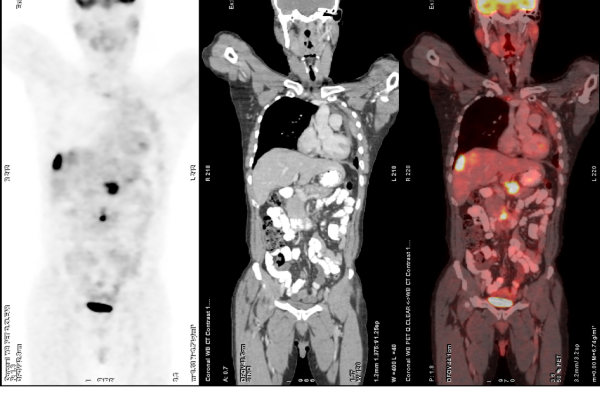 FDG-PET-CT